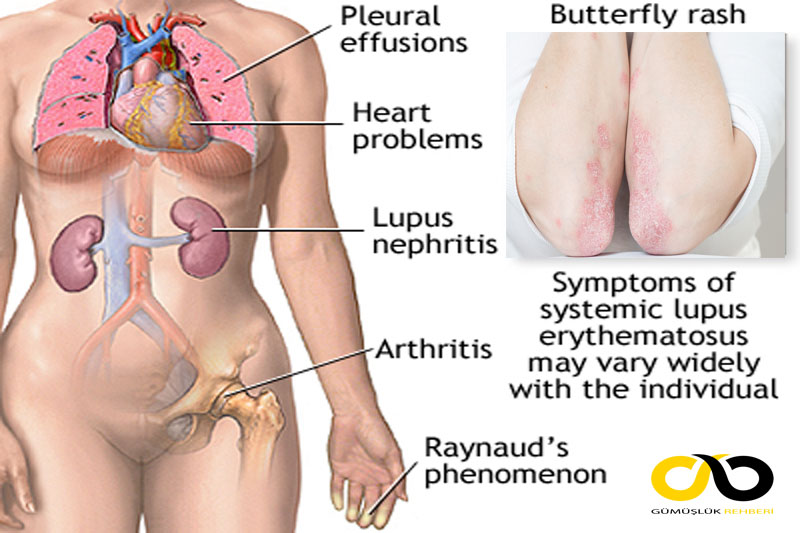 sistemik lupus eritematozus